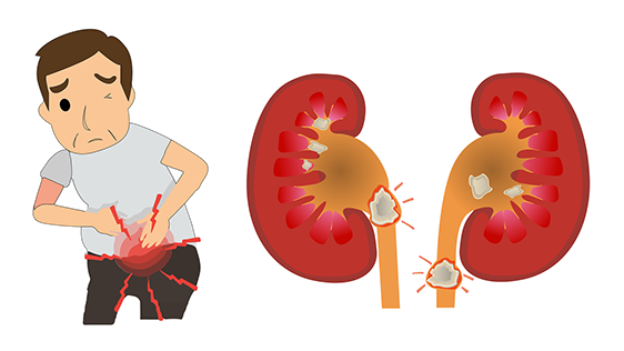 durere-pietre-la-rinichi