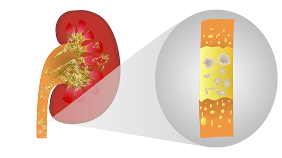 dizolva-pietrele-la-rinichi